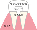 ジルコニアセラミック