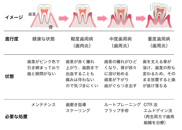歯周病の症状と必要な治療、健康な状態：歯ぐきがピンク色で引き締まっており、歯とすき間がない（必要な処置：メンテナンス）、軽度歯周病（歯肉炎）：歯ぐきが赤く腫れ上がり、歯磨きで出血することも。痛みは伴わないので、気づきにくい（必要な処置：歯磨き指導、スケーリング）、中度歯周病（歯周炎）：歯ぐきの腫れがひどくなり、骨が徐々に溶け始める。歯ぐきが下がり、歯がぐらつきだす（必要な処置：ルートプレーニング、フラップ手術）、重度歯周病（歯周炎）：歯を支える骨が溶け、歯ぐきの形も変わるため、そのまま放置すると歯が抜け落ちる（必要な処置：GTR法、エムドゲイン法（再生療法で歯周組織を治療））