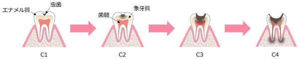 虫歯の症状と虫歯の治療方法