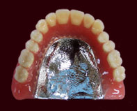 金属床の総入れ歯