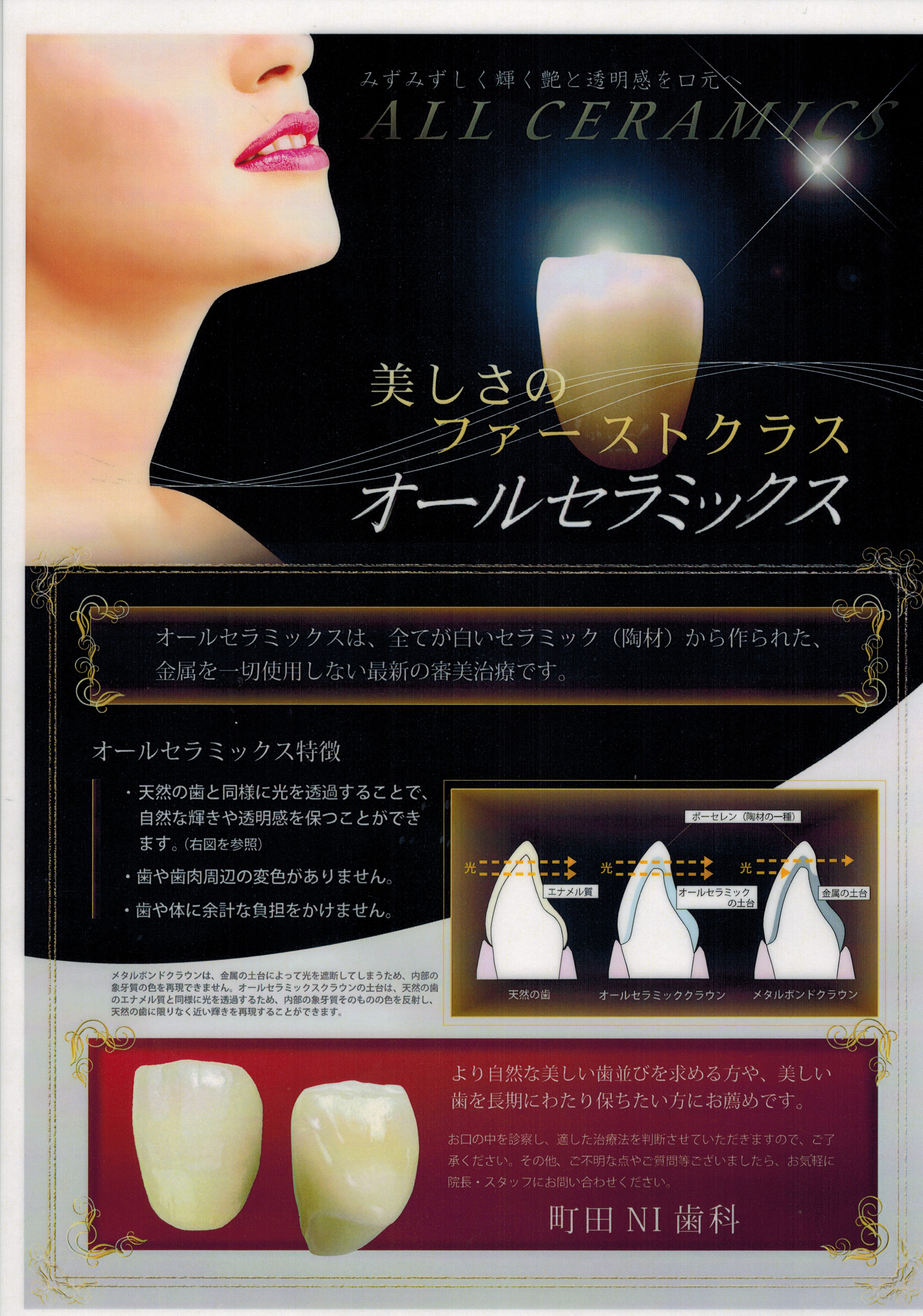 オールセラミック