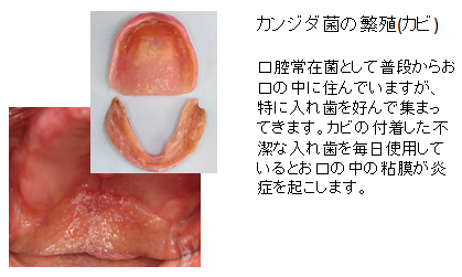 入れ歯の臭いや口臭の原因になるカンジダ菌の繁殖