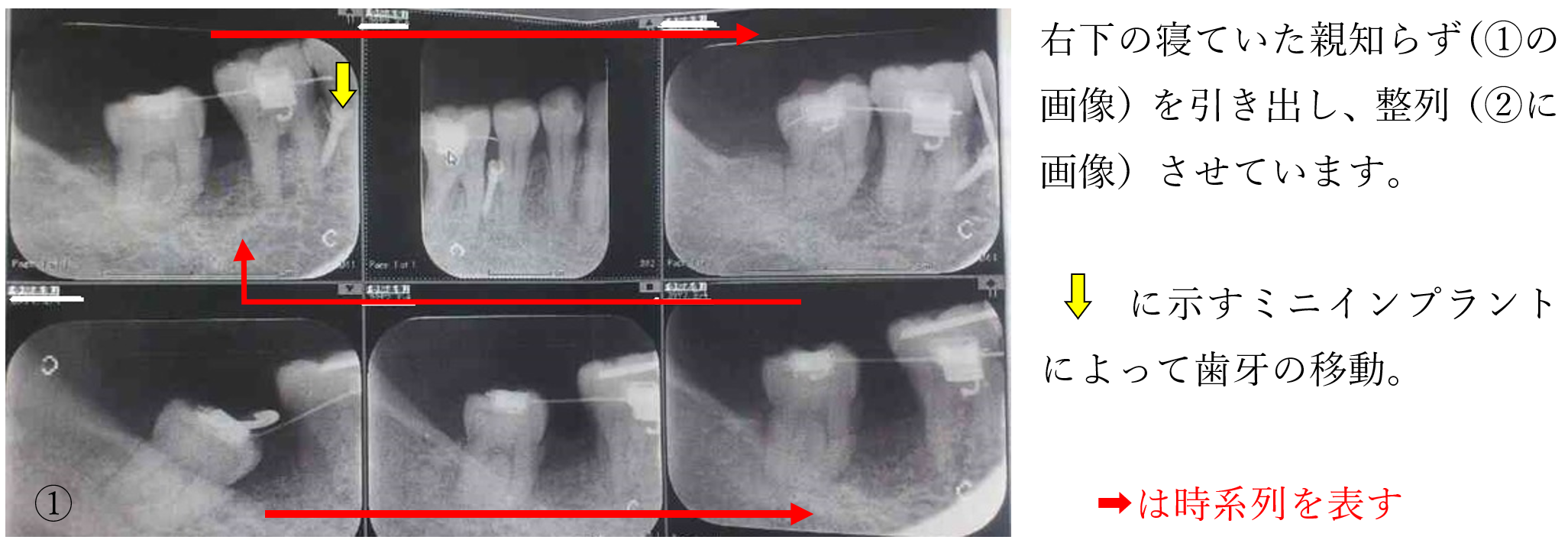 歯周病治療におけるミニインプラントと矯正治療による智歯（親知らず）の有効利用症例