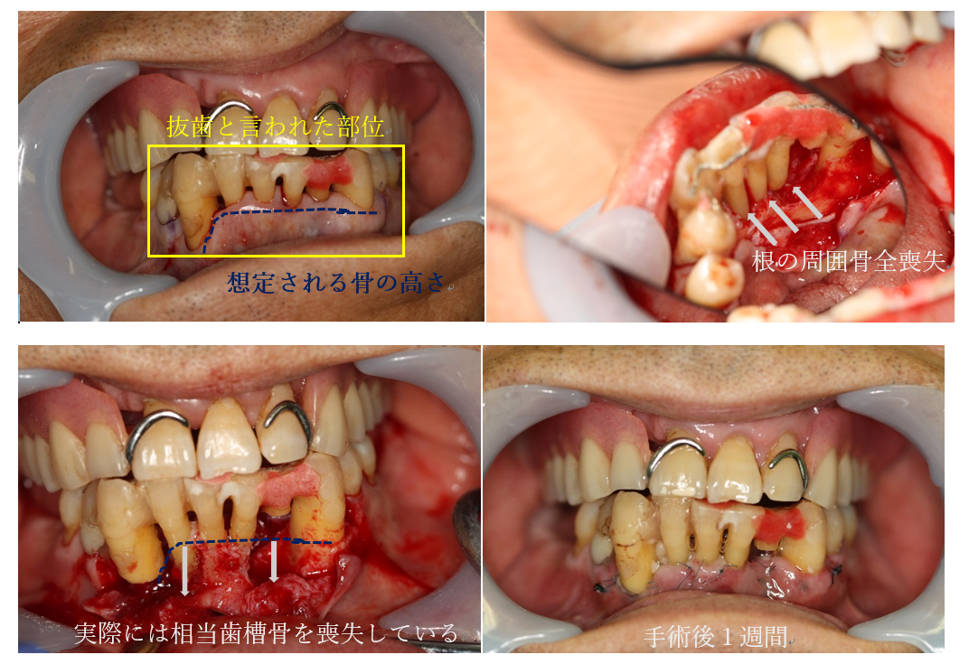 重度歯周病の治療方法・治療事例・料金 - 入れ歯・歯周病治療の歯科 