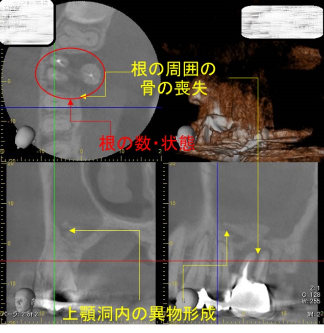 同一患者の歯科用CT画像での診断結果