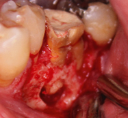 歯肉の腫れと歯槽骨の骨欠損