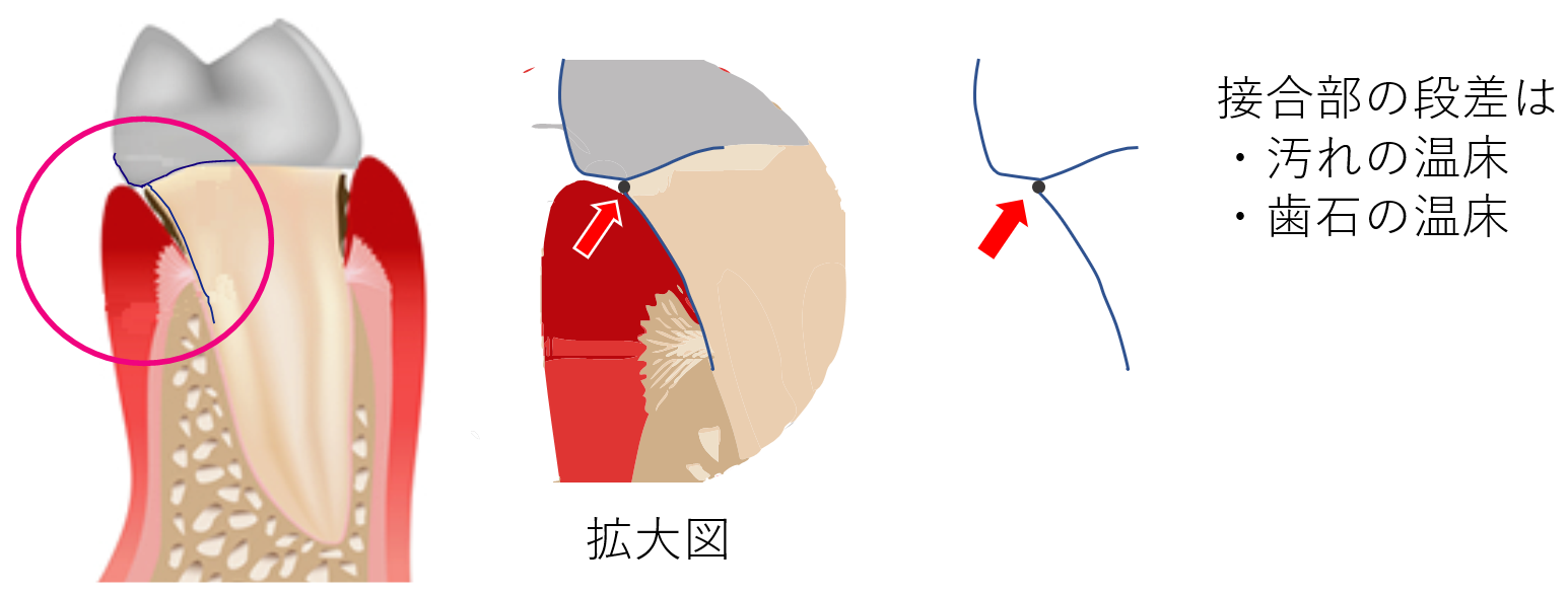 不適合冠と歯周組織